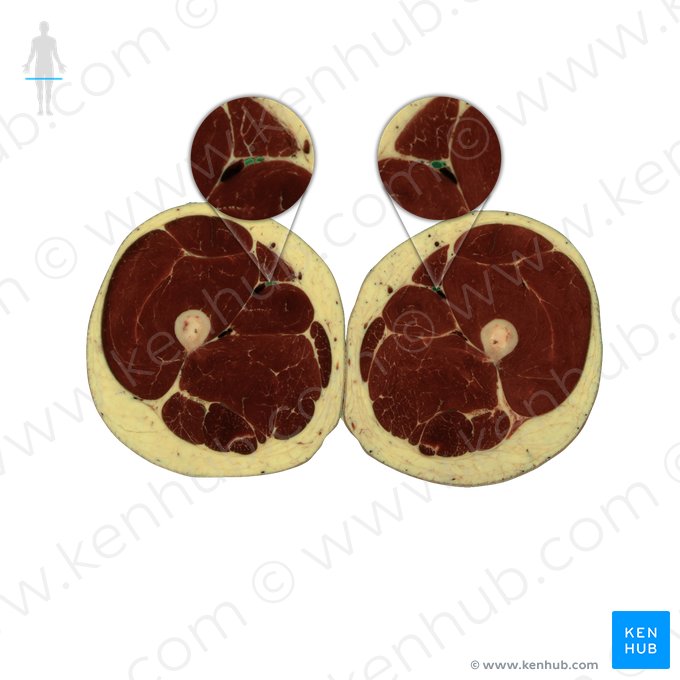 Femoral artery (Arteria femoralis); Image: National Library of Medicine