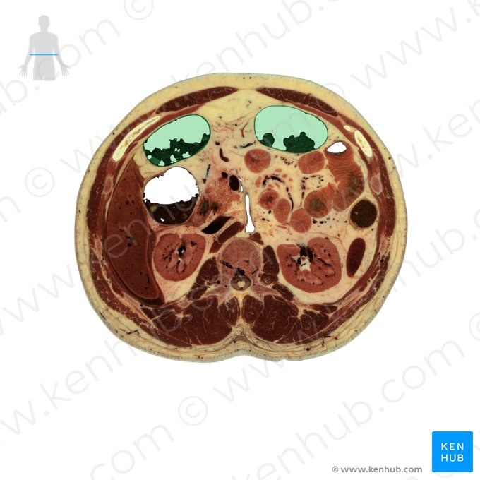 Transverse colon (Colon transversum); Image: National Library of Medicine