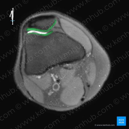 Cartilago articularis genus (Gelenkknorpel des Knies); Bild: 