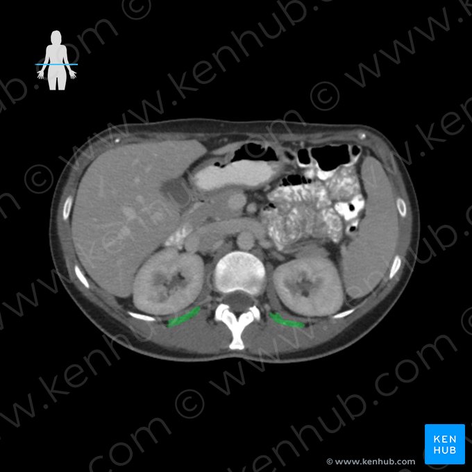 Musculus quadratus lumborum (Viereckiger Lendenmuskel); Bild: 