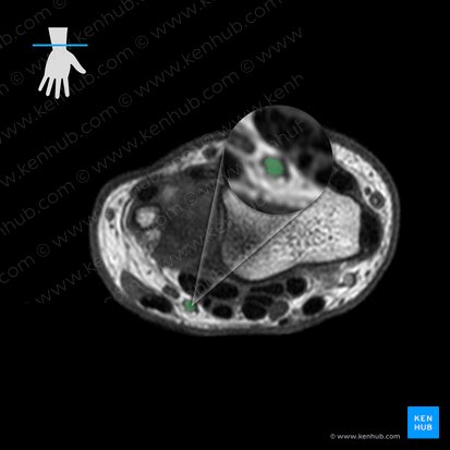 Ulnar artery (Arteria ulnaris); Image: 