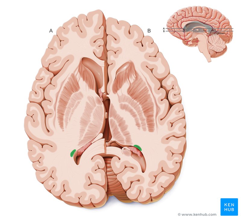 Tail of the caudate nucleus - cross-sectional view