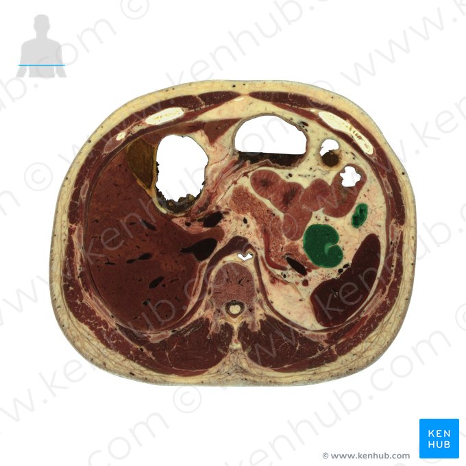 Colon descendens (Absteigender Dickdarm); Bild: National Library of Medicine