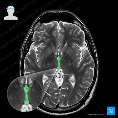 Third ventricle (Ventriculus tertius); Image: 