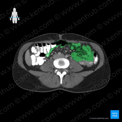 Ileum (Krummdarm); Bild: 