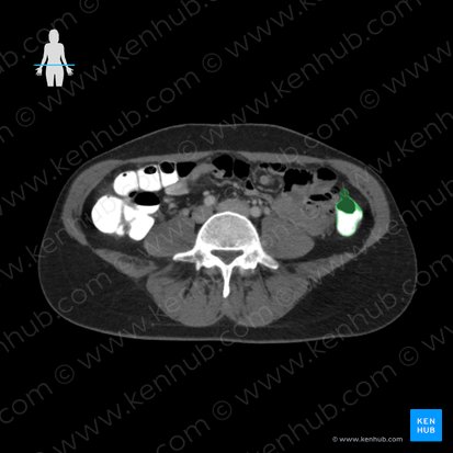 Descending colon (Colon descendens); Image: 