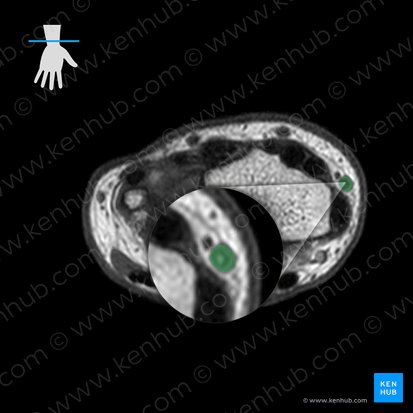 Cephalic vein (Vena cephalica); Image: 