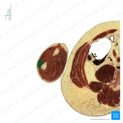 Musculus extensor carpi ulnaris (Ellenseitiger Handstrecker); Bild: National Library of Medicine