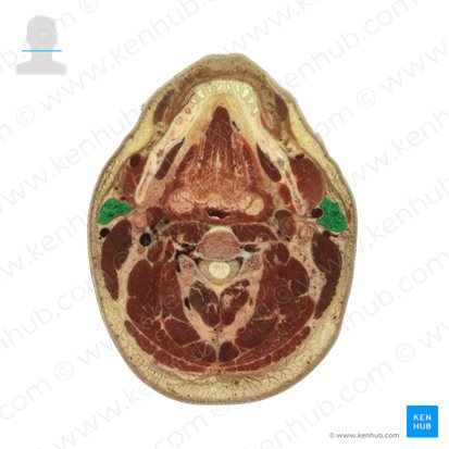 Glande parotide (Glandula parotidea); Image : National Library of Medicine