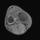 Knee (MRI)