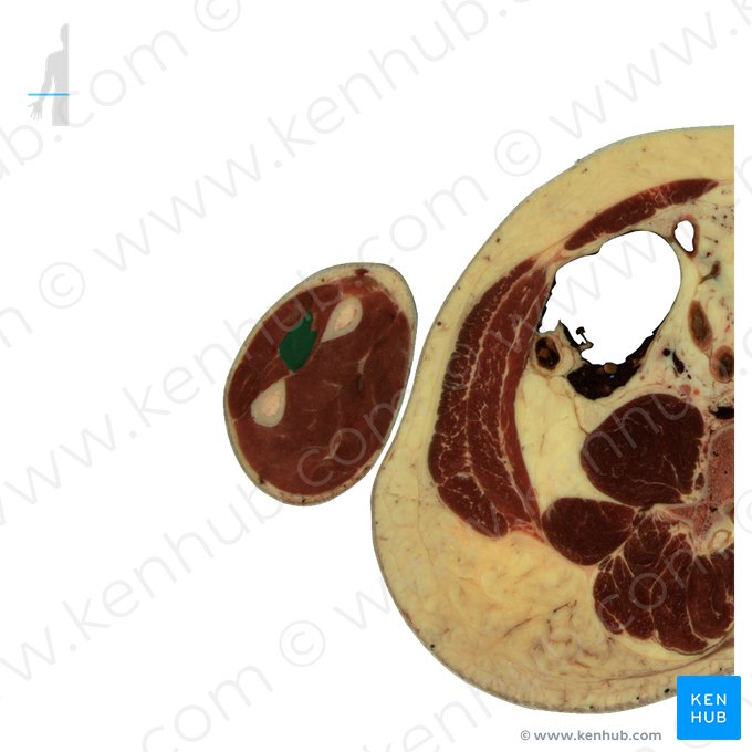 Músculo abdutor longo do polegar (Musculus abductor pollicis longus); Imagem: National Library of Medicine