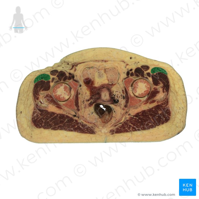 Musculus tensor fasciae latae (Schenkelbindenspanner); Bild: National Library of Medicine