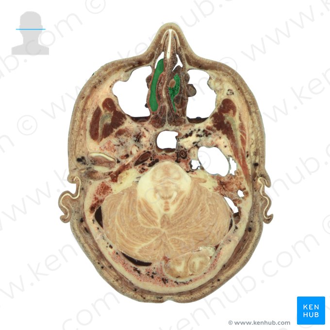 Concha nasal média (Concha media nasi ossis ethmoidalis); Imagem: National Library of Medicine