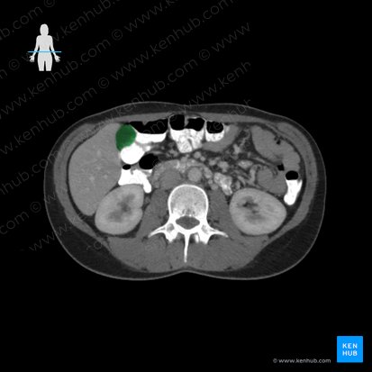 Gallbladder (Vesica biliaris); Image: 