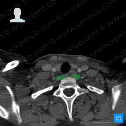 Longus colli muscle (Musculus longus colli); Image: 