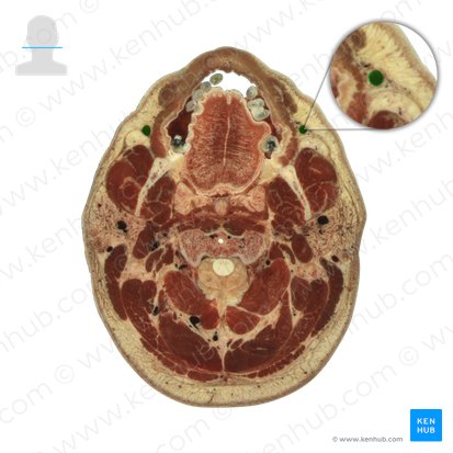 Vena facialis (Gesichtsvene); Bild: National Library of Medicine