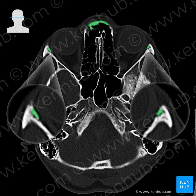 Frontal bone (Os frontale); Image: 