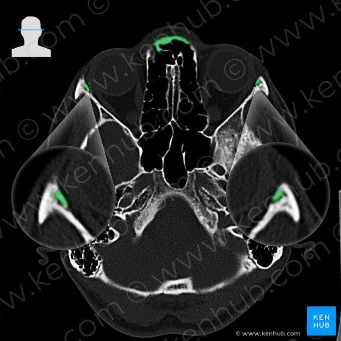 Hueso frontal (Os frontale); Imagen: 