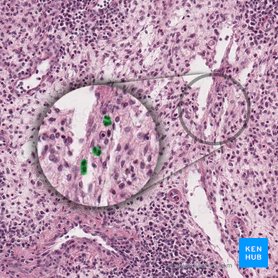 Mastocitos (Mastocytus); Imagen: 