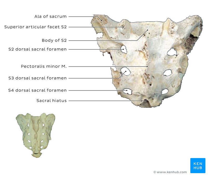 Sacrum of patient with S1 lumbarization