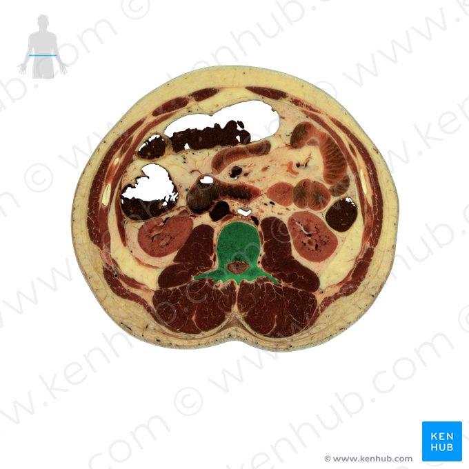 Vértebra L2 (Vertebra L2); Imagem: National Library of Medicine