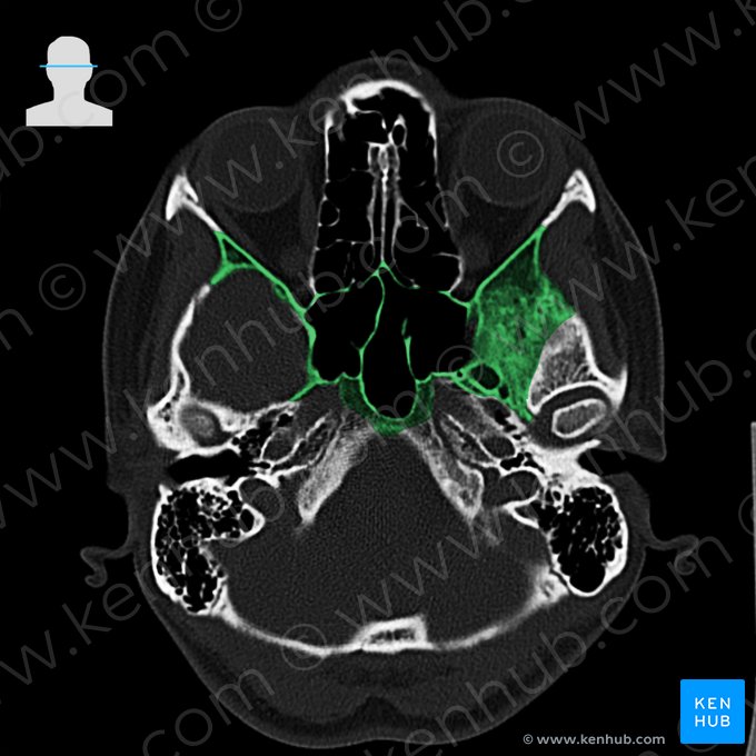 Sphenoid bone (Os sphenoidale); Image: 