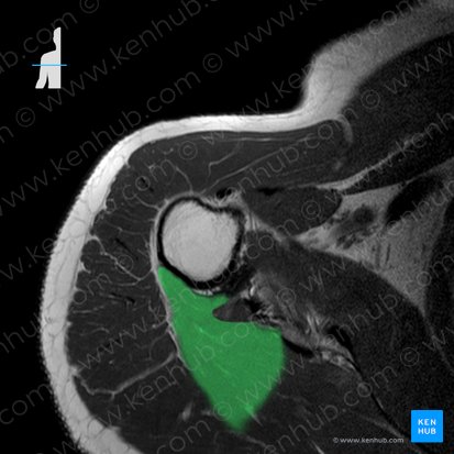 Músculo redondo menor (Musculus teres minor); Imagen: 