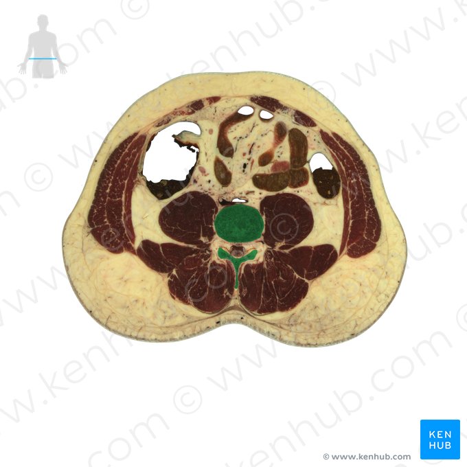 Vertebra L4 (Wirbel L4); Bild: National Library of Medicine