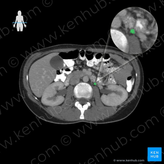 Left ovarian vein (Vena ovarica sinistra); Image: 