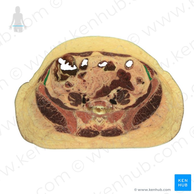 Músculo transverso do abdome (Musculus transversus abdominis); Imagem: National Library of Medicine