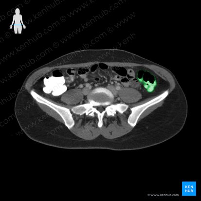 Descending colon (Colon descendens); Image: 