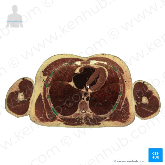 Musculi intercostales externi (Äußere Zwischenrippenmuskeln); Bild: National Library of Medicine