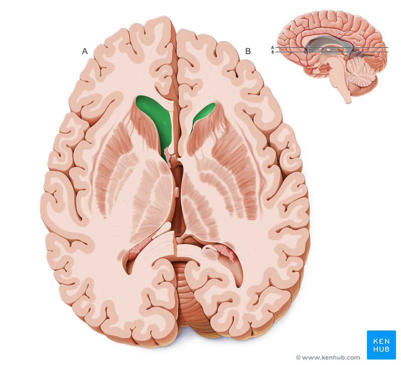 Anterior horn of the lateral ventricle - cross-sectional view