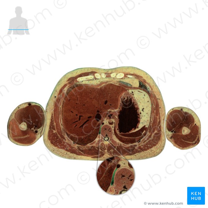 Vena intercostalis posterior (Hintere Zwischenrippenvene); Bild: National Library of Medicine