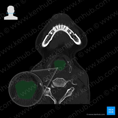 Laryngopharynx (Pars laryngea pharyngis); Image: 