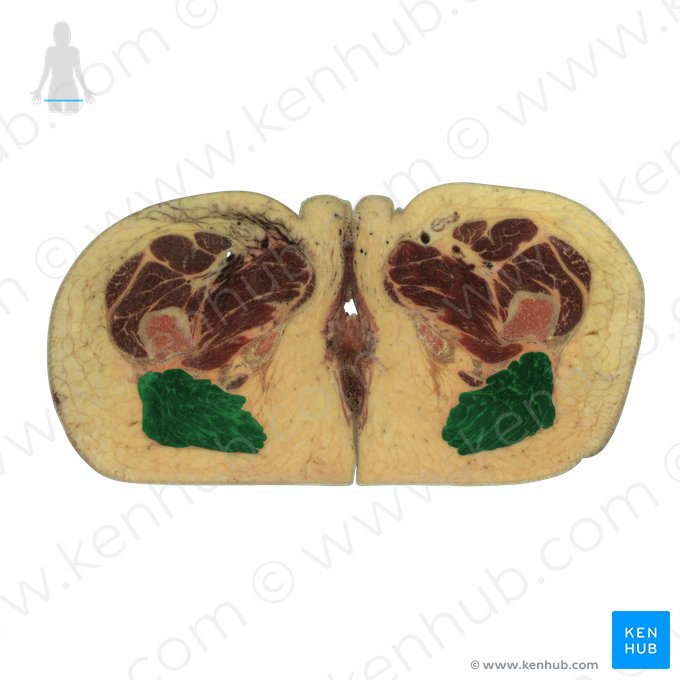 Gluteus maximus muscle (Musculus gluteus maximus); Image: National Library of Medicine