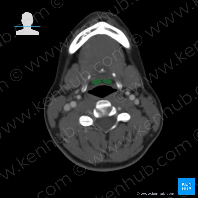 Vallécula epiglótica (Vallecula epiglottica); Imagen: 