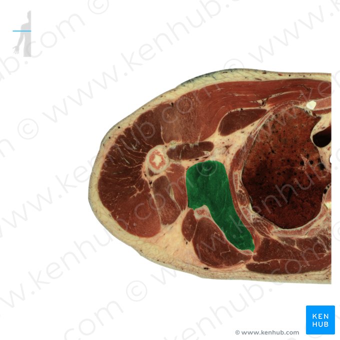 Músculo subescapular (Musculus subscapularis); Imagem: National Library of Medicine