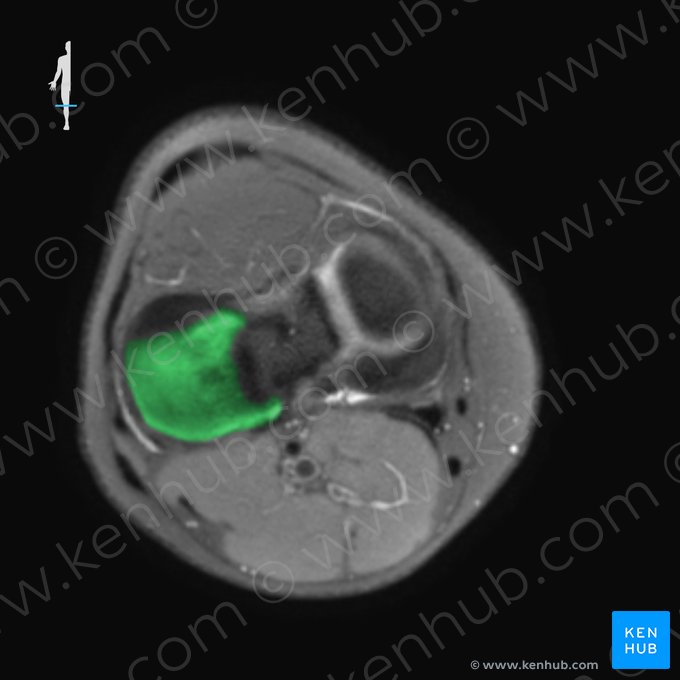 Côndilo lateral da tíbia (Condylus lateralis tibiae); Imagem: 