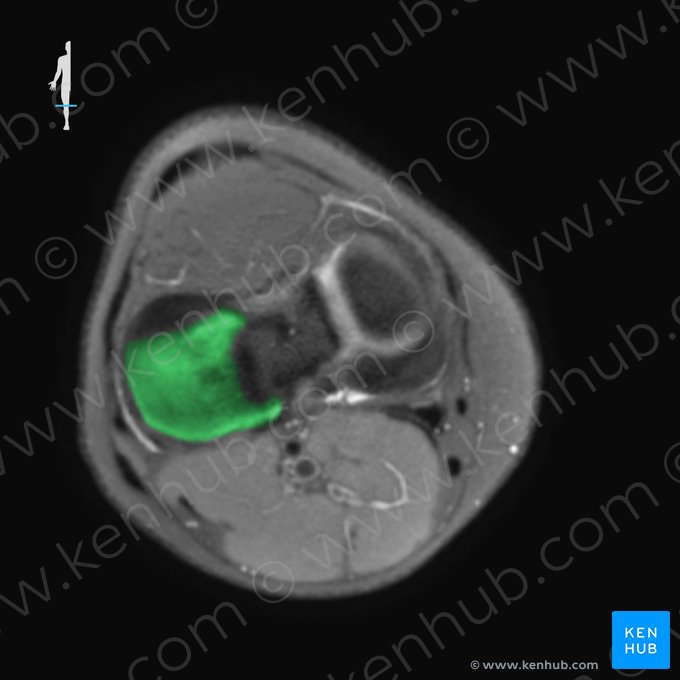 Lateral condyle of tibia (Condylus lateralis tibiae); Image: 