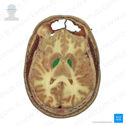 Globus pallidus (Blasser Kern); Bild: National Library of Medicine