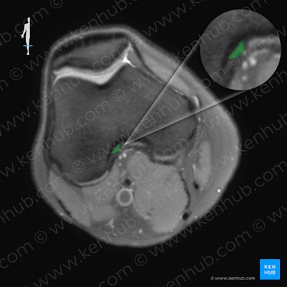 Ligamentum cruciatum anterius (Vorderes Kreuzband); Bild: 