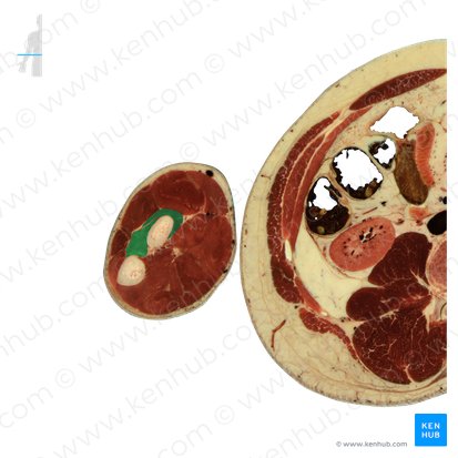 Músculo supinador (Musculus supinator); Imagen: National Library of Medicine