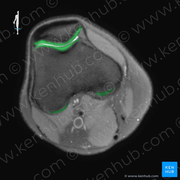 Cartilagem articular do joelho (Cartilago articularis genus); Imagem: 