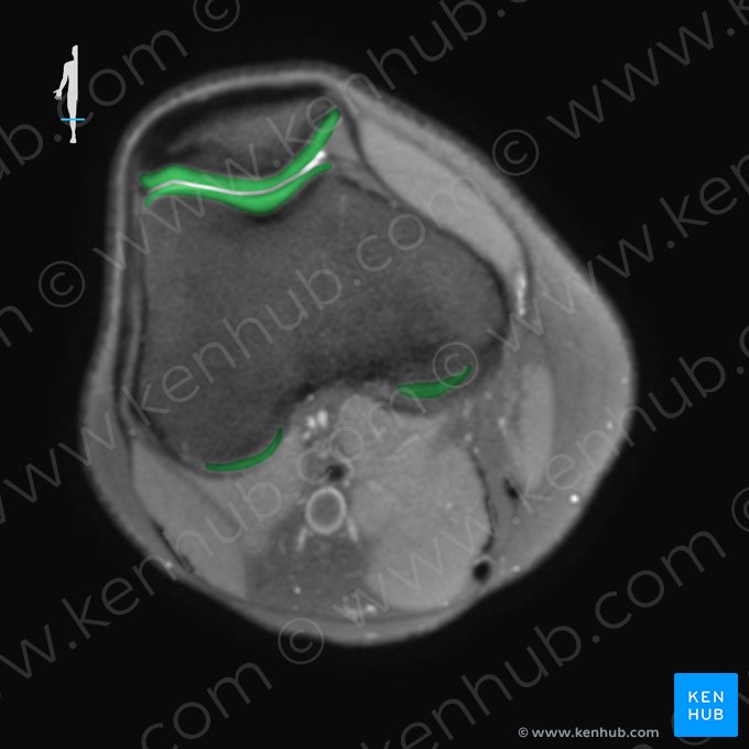 Cartílago articular de la rodilla (Cartilago articularis genus); Imagen: 