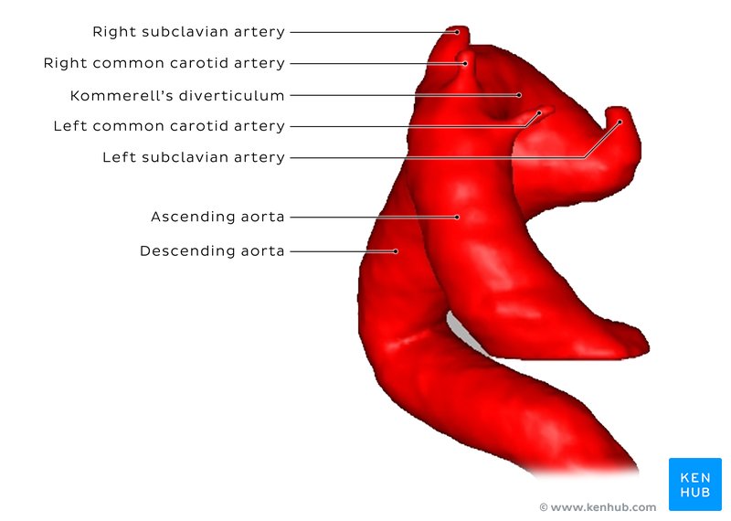 Right-sided aortic arch with a Kommerell’s diverticulum - 3D reconstruction