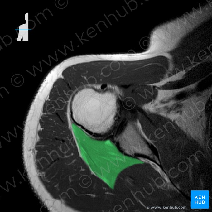 Músculo redondo menor (Musculus teres minor); Imagen: 