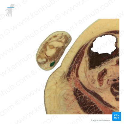 Tendão do músculo flexor ulnar do carpo (Tendo musculi flexoris carpi ulnaris); Imagem: National Library of Medicine