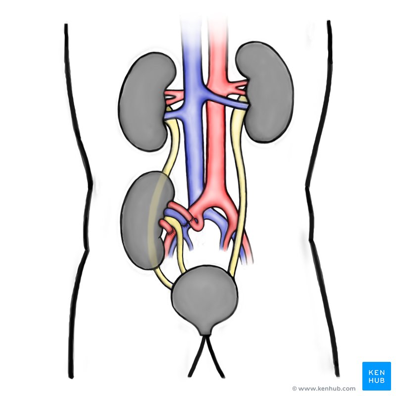 Implanted kidney