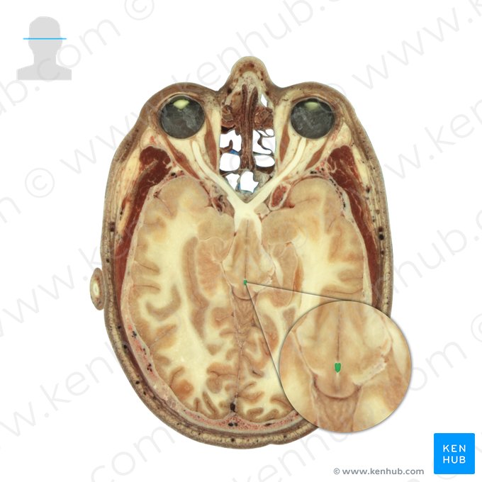 Commissura posterior (Hintere Querverbindung); Bild: National Library of Medicine